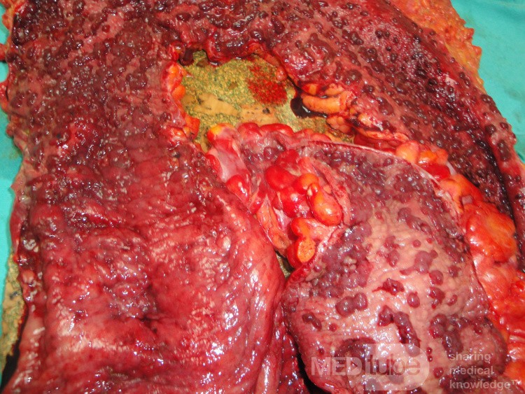 Multiple Rectal Ulcers (93 of 110)