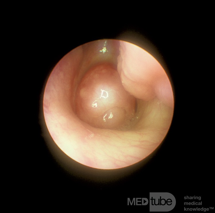 Choanal Polyp
