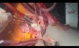 Patient with Biatrial Mass 2 and CVA Undergone Extensive Surgery 