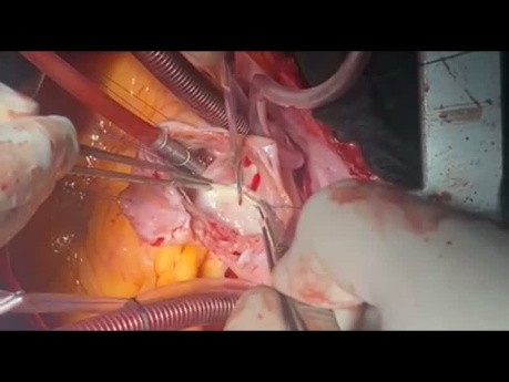 Patient with Biatrial Mass 2 and CVA Undergone Extensive Surgery 