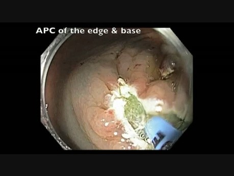 Cecum - Subtle Flat Lesion - EMR
