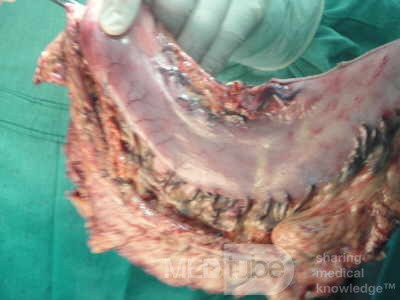 Gastric Ulcerated Adenocarcinoma of the Pre-pyloric Antrum (17 of 28)