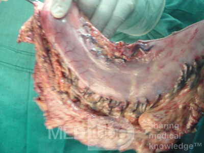 Gastric Ulcerated Adenocarcinoma of the Pre-pyloric Antrum (17 of 28)