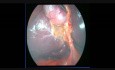 Laparoscopic 3 Ports Cholecystectomy