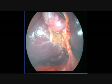 Laparoscopic 3 Ports Cholecystectomy