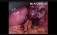 Laparoscopic Management of Ovarian Ectopic Pregnancy