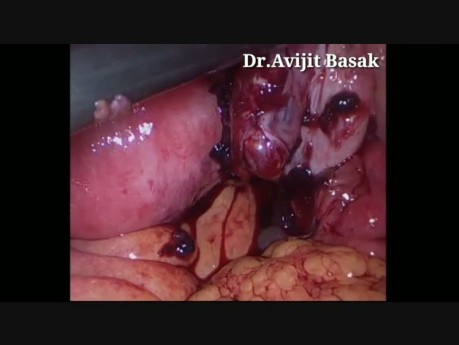 Laparoscopic Management of Ovarian Ectopic Pregnancy
