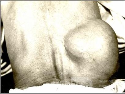 Large Lumbar Hernia