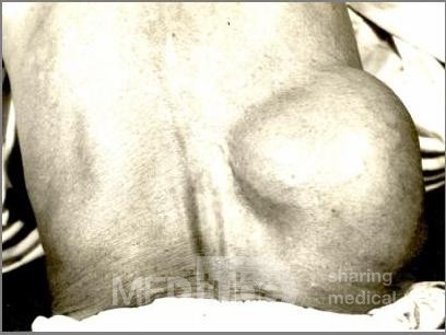 Large Lumbar Hernia
