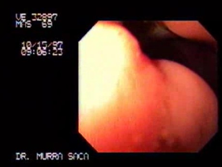 Duodenal Ulcers