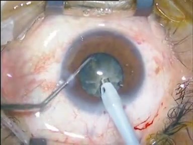 Phacoemulsification - Chopper Usage 