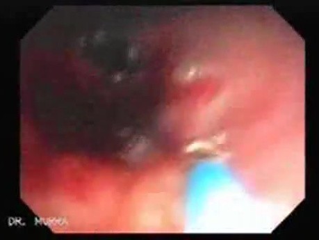 Endoscopic Resection of Giant Tubulo-Villous of the rectum (34 of 35)