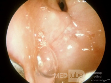 Kartagener's Syndrome