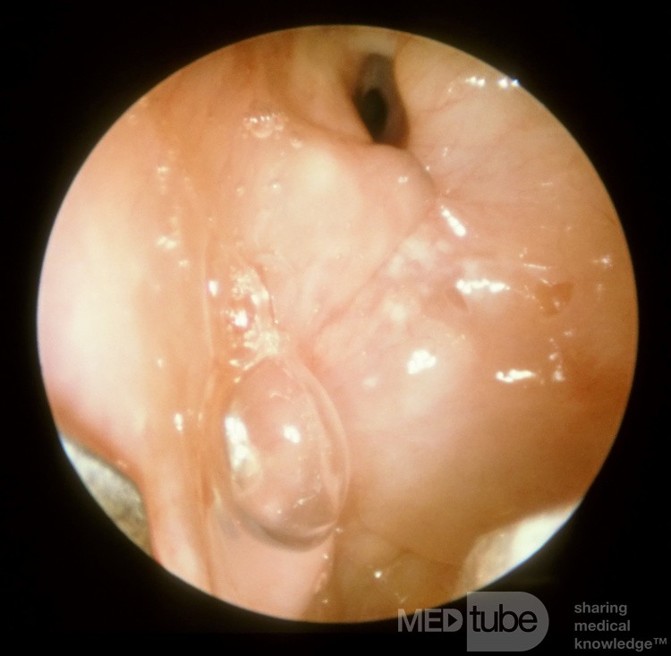 Kartagener's Syndrome