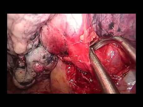 Uniportal VATS Anatomic Left Upper Trisegmentectomy (non edited)