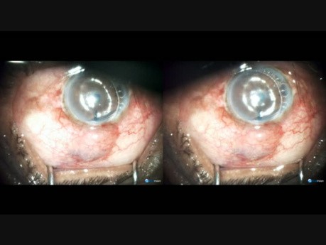 PC IOL, Open Angle Glaucoma, Microtrack Filtration, In 3D also 2D