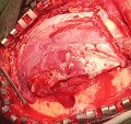 Decompressive Craniotomy