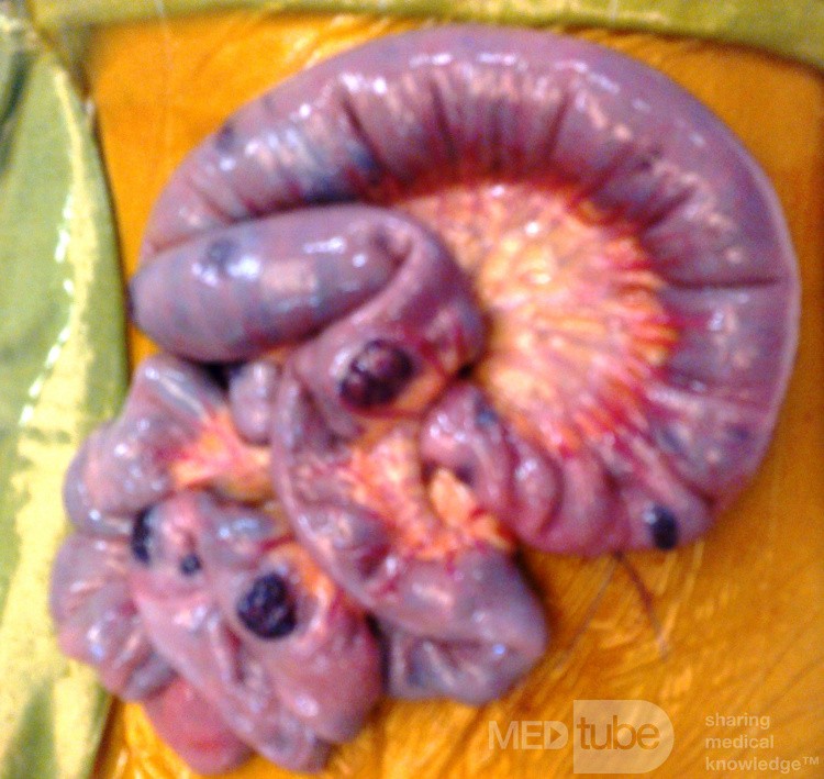 Blue Rubber Bleb Naevus Syndrome