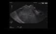 Endoscopic Ultrasound of Pancreatic Tail Mass with Liver Secondaries
