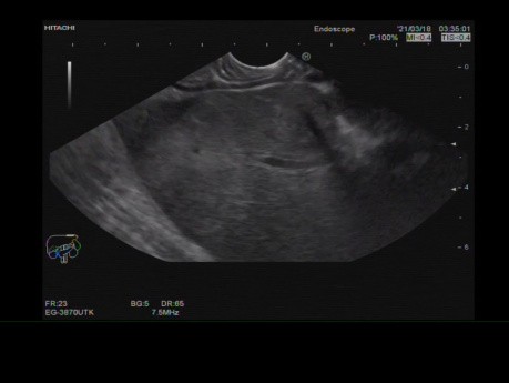Endoscopic Ultrasound of Pancreatic Tail Mass with Liver Secondaries