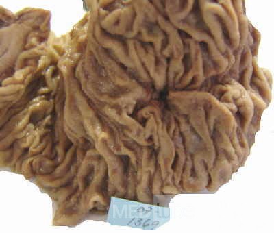 Cholangiocarcinoma that infiltrated a Periampullary Duodenal Diverticula and the head of the pancreas (6 of 20)