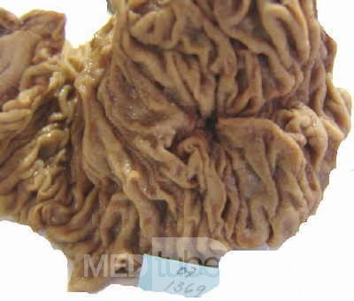 Cholangiocarcinoma that infiltrated a Periampullary Duodenal Diverticula and the head of the pancreas (6 of 20)