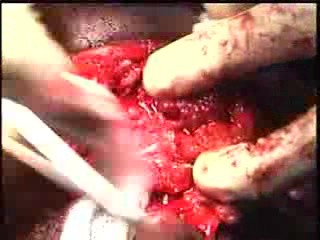 Parotidectomy