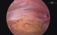 Left Inguinal Hernia - Laparoscopic Repair