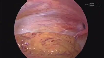 Left Inguinal Hernia - Laparoscopic Repair