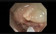 Colonoscopy - Sigmoid Colon EMR in a Patient with Prior Failed Resections