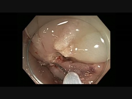Colonoscopy - Sigmoid Colon EMR in a Patient with Prior Failed Resections