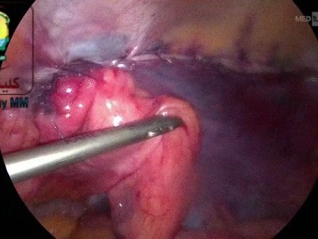 Excess Sac is Used to Reinforce