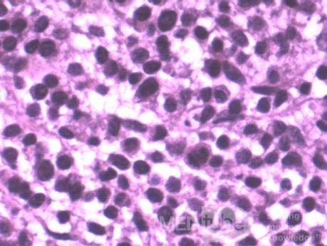 Colon Angiodysplasia and Multiple Myeloma (23 of 24)
