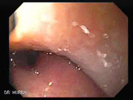 Uvula with Herpes