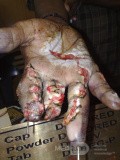 Crush Injury Of Left Hand After Surgical Intervention