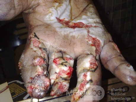Crush Injury Of Left Hand After Surgical Intervention