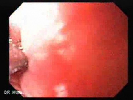 Squamous cell carcinoma of the larynx 73-year-old smoker (2 of 4)