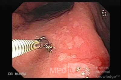 Gastric Cancer - Intestinal Metaplasia - Endoscopy (7 of 7)