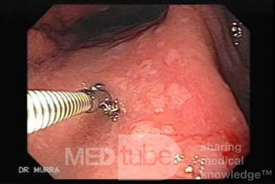 Gastric Cancer - Intestinal Metaplasia - Endoscopy (7 of 7)