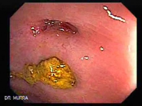 Acute Diverticulitis (2 of 5)