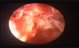 Attic Cholesteatoma with CSF Otorrhoea