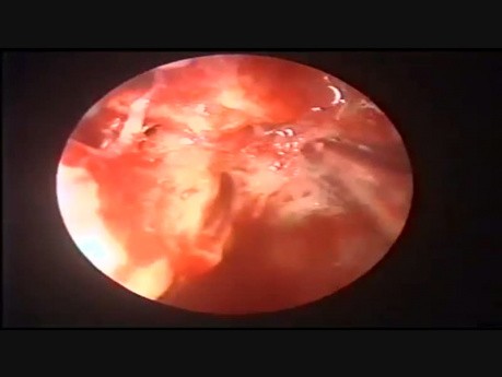 Attic Cholesteatoma with CSF Otorrhoea