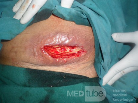 Carbuncle - Anterior Abdominal Wall 2