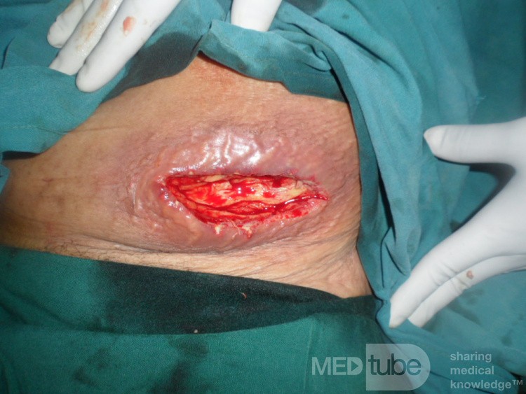 Carbuncle - Anterior Abdominal Wall 2