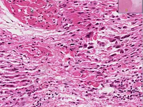 Rheumatic fever - Heart - Histopathology