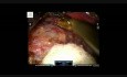 Robotic Right Adrenalectomy