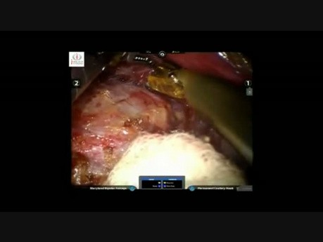Robotic Right Adrenalectomy