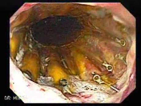 Adenocarcinoma of the Cardia and Carcinoma Epidermoid of the Larynx (13 of 26)