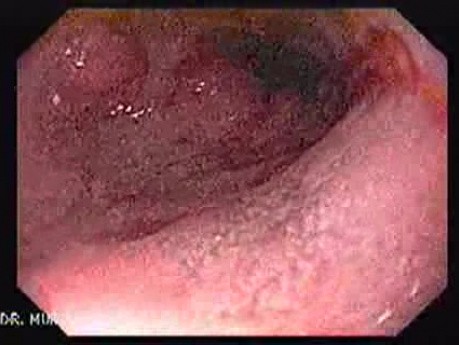 Reflux Esophagitis & Esophageal Squamous Cell Papilloma - Esophagoscopy