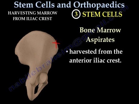 Stem Cells in Orthopaedics - Video Lecture